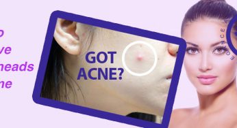 How to Get Rid of Whiteheads Fast at Home
