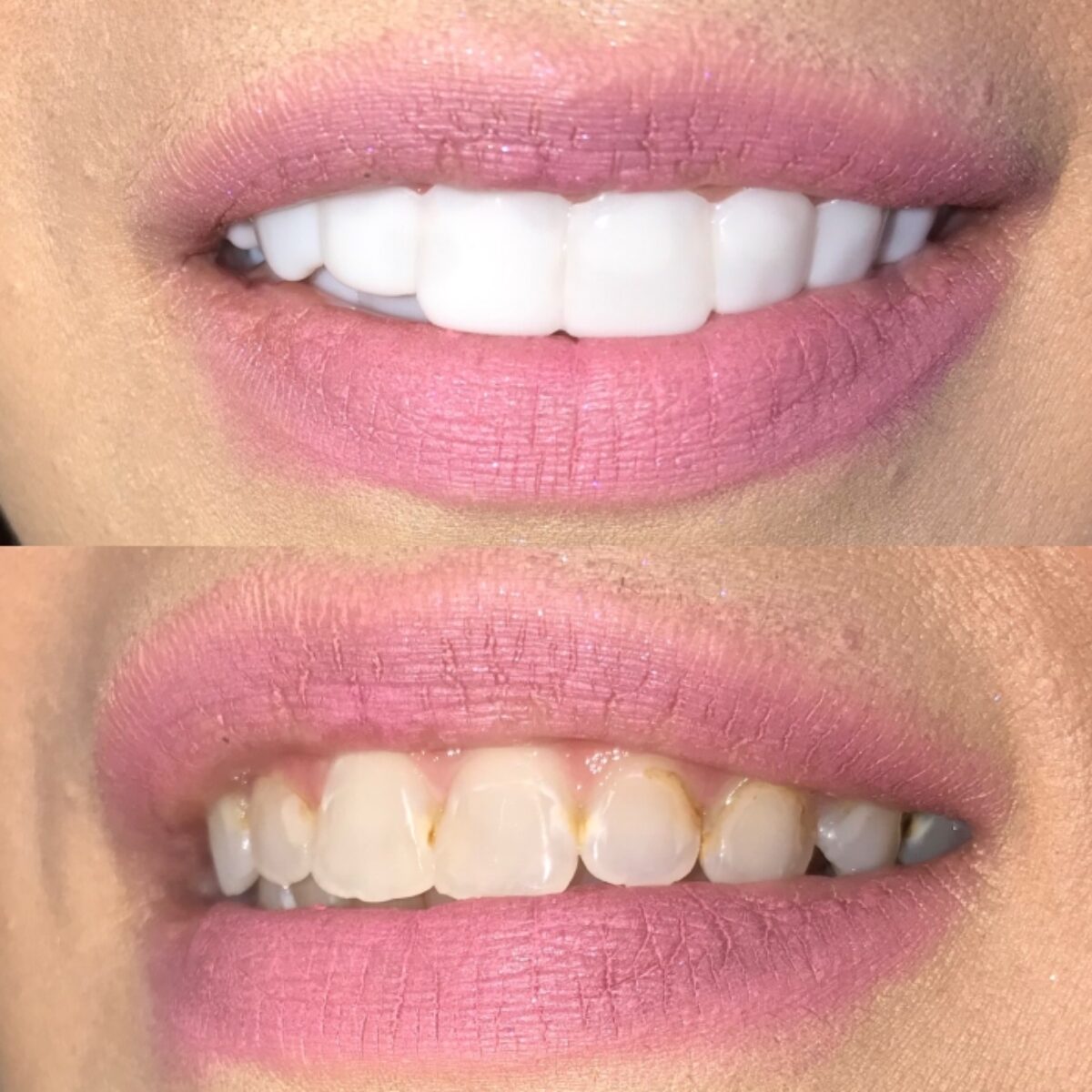 Clip On Veneers Reviews