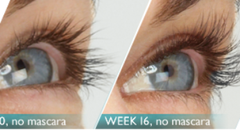 Is Latisse Worth It for Eyelash Growth?