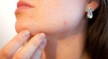 How to get rid of acne scars fast ?